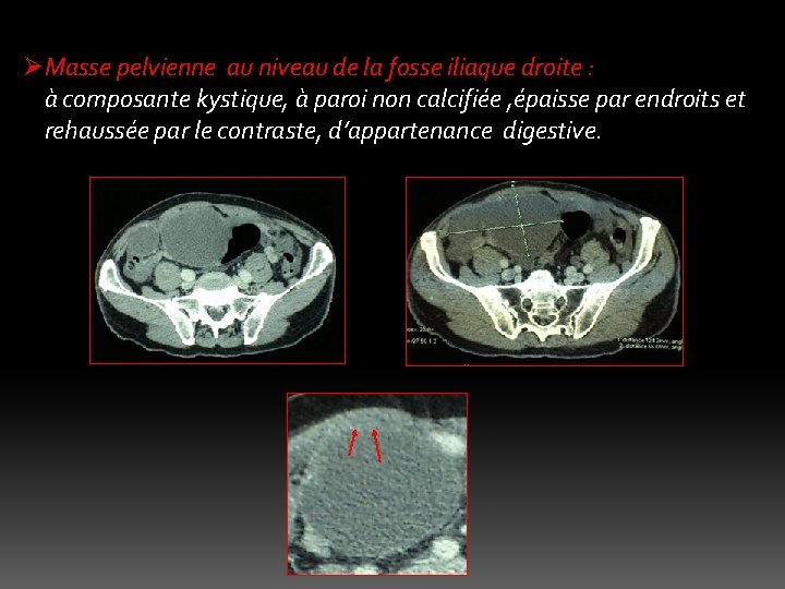 ØMasse pelvienne au niveau de la fosse iliaque droite : à composante kystique, à