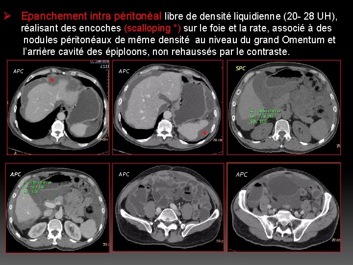 Ø Epanchement intra péritonéal libre de densité liquidienne (20 - 28 UH), réalisant des