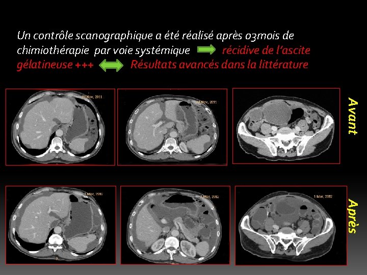 Un contrôle scanographique a été réalisé après 03 mois de chimiothérapie par voie systémique