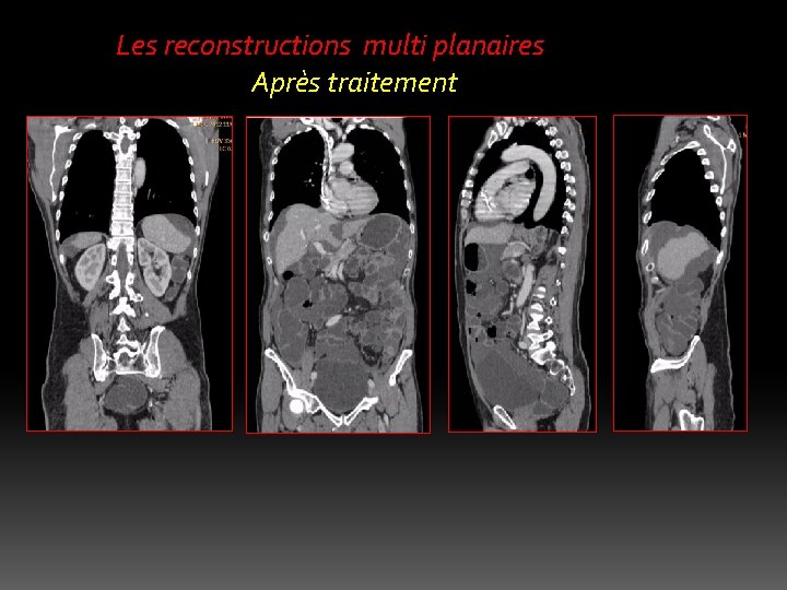 Les reconstructions multi planaires Après traitement 