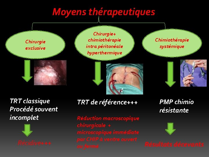 Moyens thérapeutiques Chirurgie exclusive TRT classique Procédé souvent incomplet Récidive+++ Chirurgie+ chimiothérapie intra péritonéale