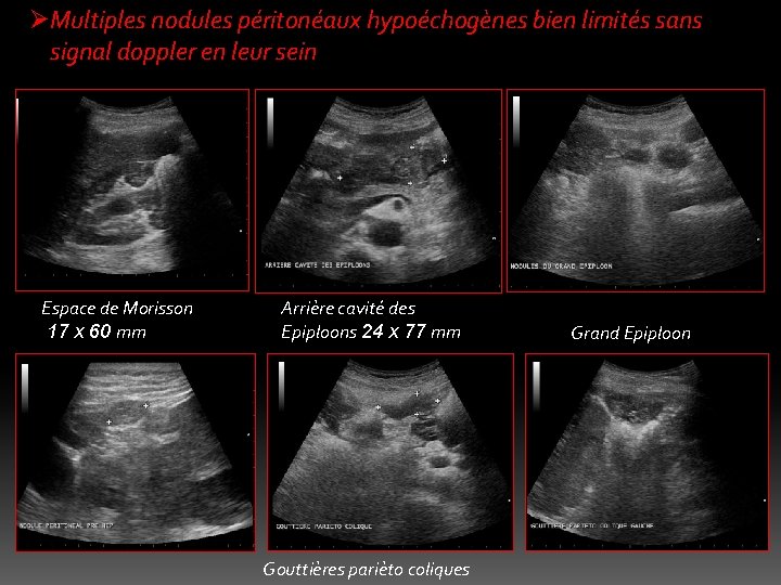 ØMultiples nodules péritonéaux hypoéchogènes bien limités sans signal doppler en leur sein Espace de