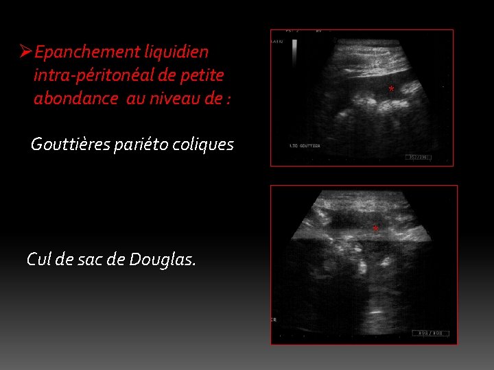 ØEpanchement liquidien intra-péritonéal de petite abondance au niveau de : * Gouttières pariéto coliques