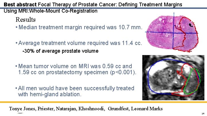 Best abstract Focal Therapy of Prostate Cancer: Defining Treatment Margins Using MRI: Whole-Mount Co-Registration
