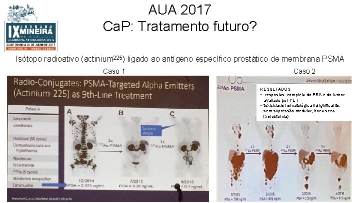 AUA 2017 Ca. P: Tratamento futuro? Isótopo radioativo (actinium 225) ligado ao antígeno específico