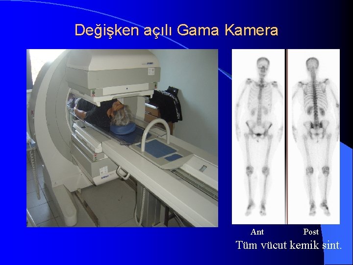 Değişken açılı Gama Kamera Ant Post Tüm vücut kemik sint. 