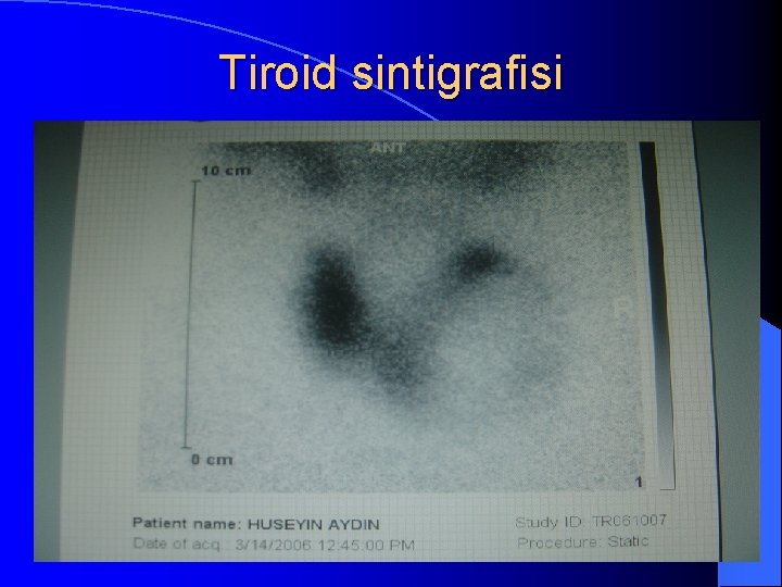 Tiroid sintigrafisi 