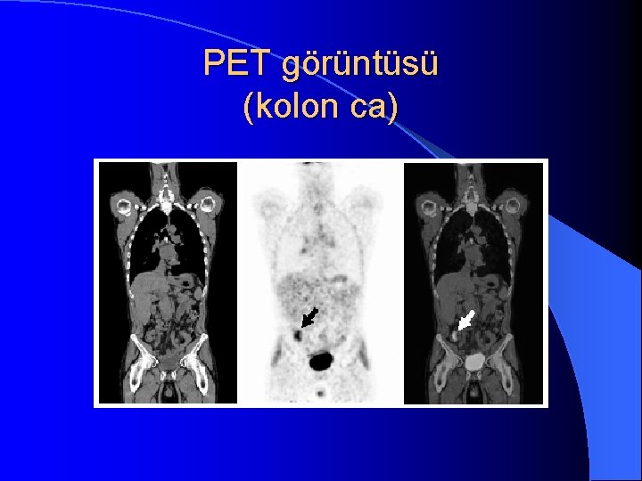 PET görüntüsü (kolon ca) 