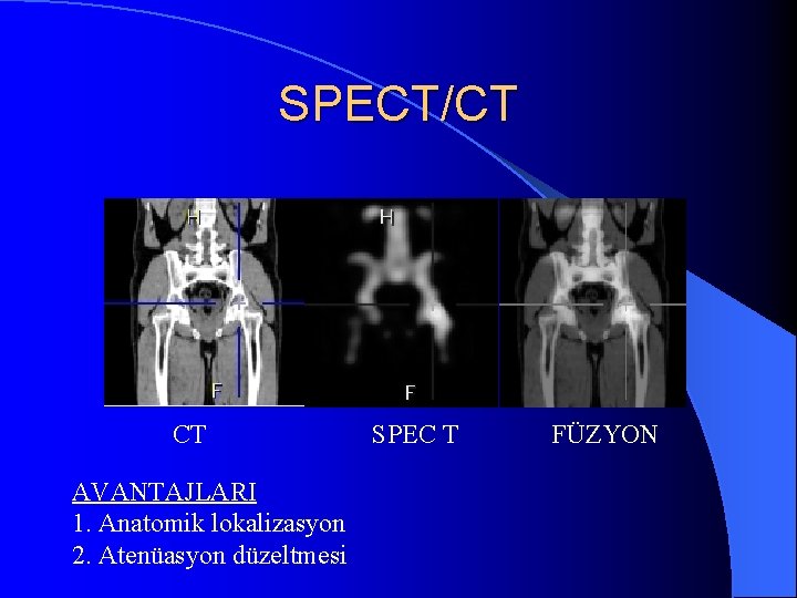 SPECT/CT CT AVANTAJLARI 1. Anatomik lokalizasyon 2. Atenüasyon düzeltmesi SPEC T FÜZYON 