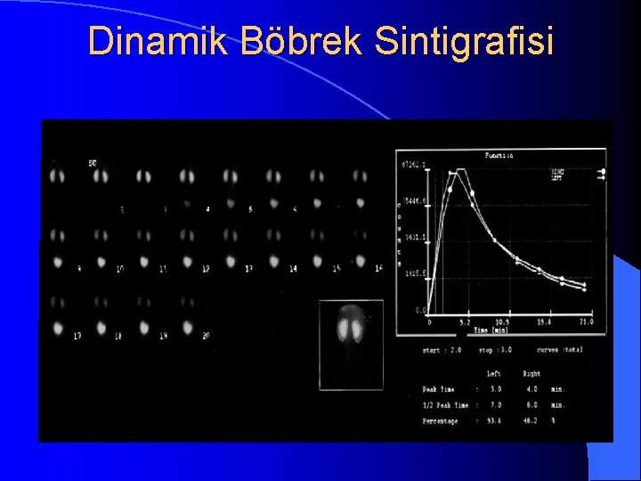 Dinamik Böbrek Sintigrafisi 