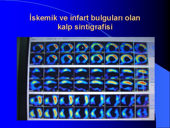 İskemik ve infart bulguları olan kalp sintigrafisi 