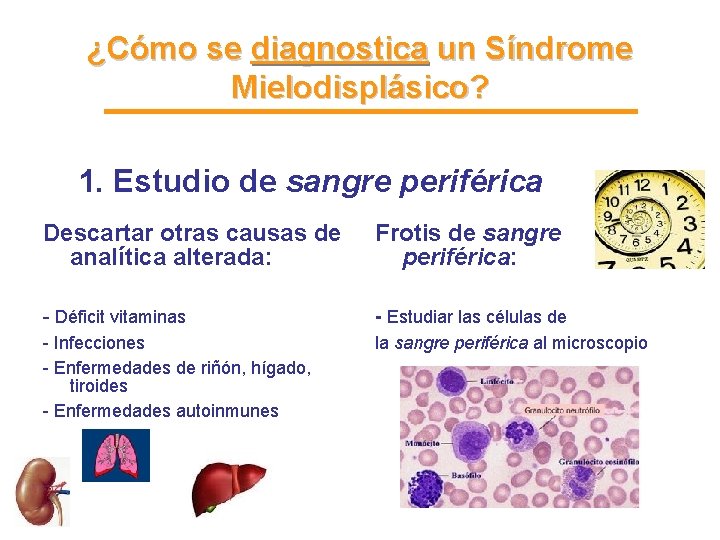 ¿Cómo se diagnostica un Síndrome Mielodisplásico? 1. Estudio de sangre periférica Descartar otras causas ¿Cómo se diagnostica un Síndrome Mielodisplásico? 1. Estudio de sangre periférica Descartar otras causas