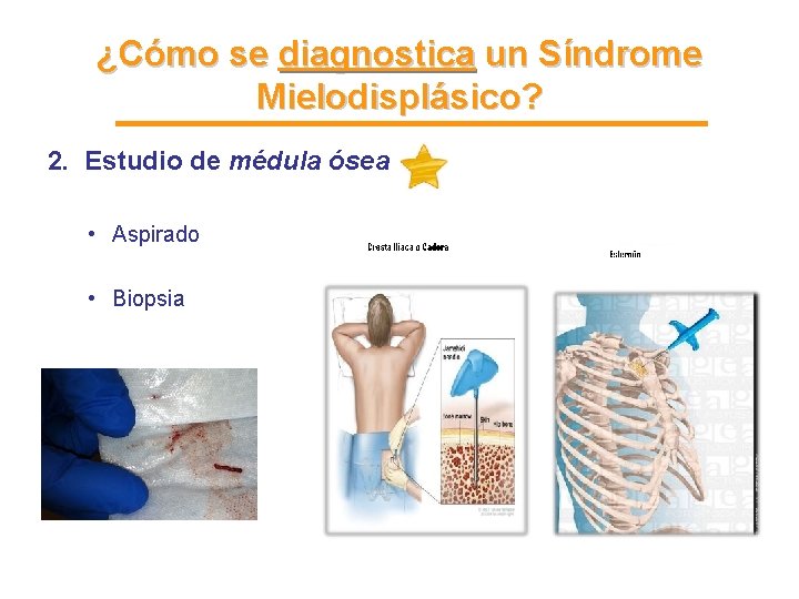 ¿Cómo se diagnostica un Síndrome Mielodisplásico? 2. Estudio de médula ósea • Aspirado • ¿Cómo se diagnostica un Síndrome Mielodisplásico? 2. Estudio de médula ósea • Aspirado •