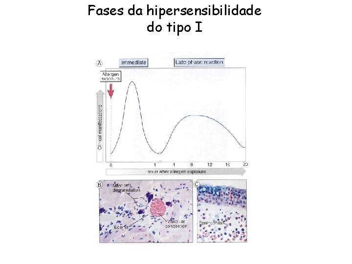 Fases da hipersensibilidade do tipo I 