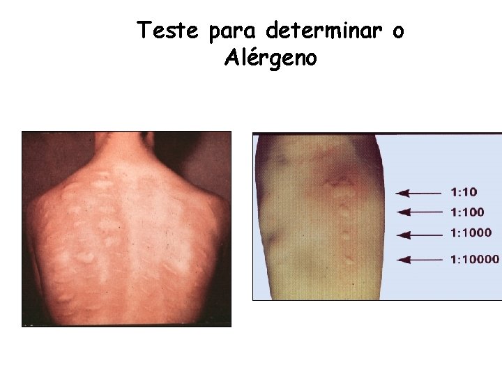 Teste para determinar o Alérgeno 