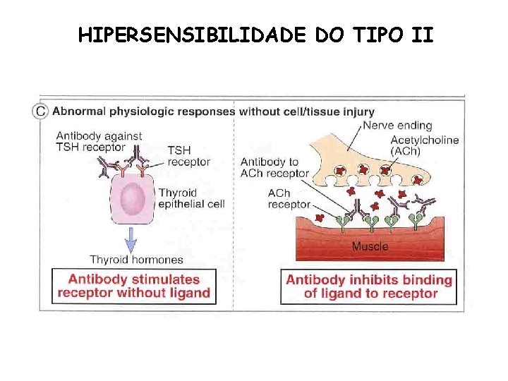 HIPERSENSIBILIDADE DO TIPO II 