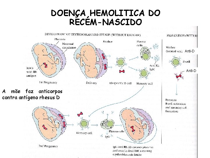 DOENÇA HEMOLITICA DO RECÉM-NASCIDO Anti-D A mãe faz anticorpos contra antígeno rhesus D 