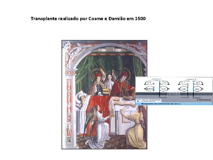 Transplante realizado por Cosme e Damião em 1500 