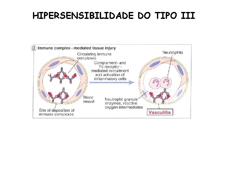 HIPERSENSIBILIDADE DO TIPO III 