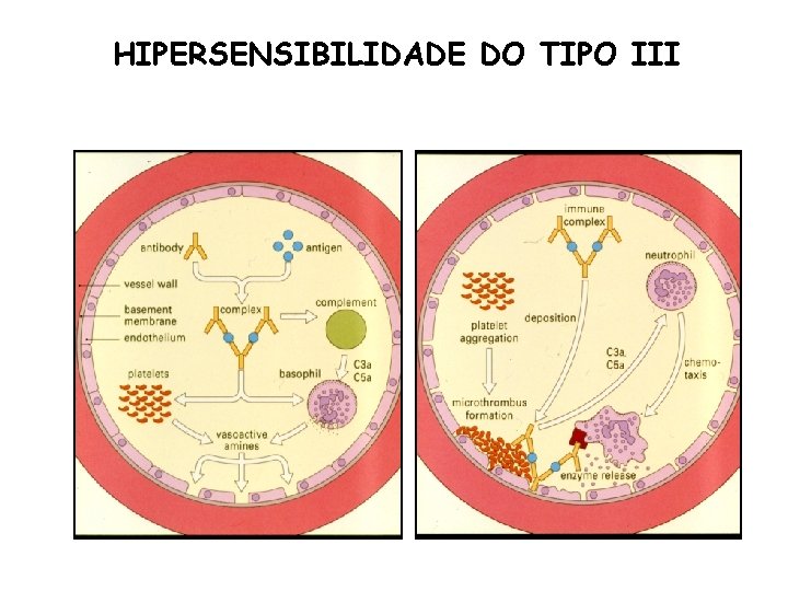 HIPERSENSIBILIDADE DO TIPO III 