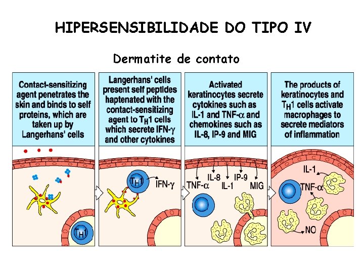 HIPERSENSIBILIDADE DO TIPO IV Dermatite de contato 