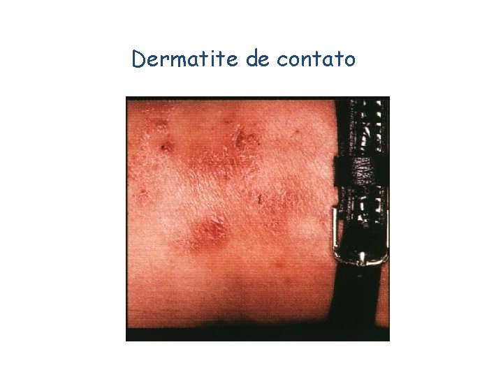 Dermatite de contato 