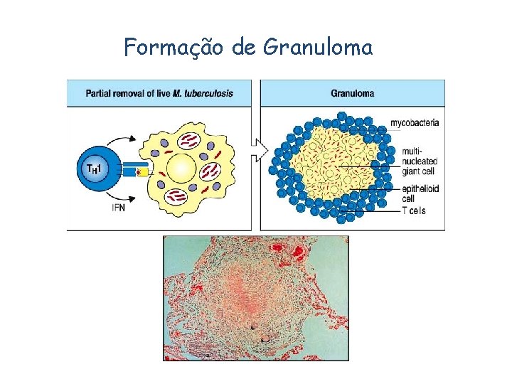 Formação de Granuloma 