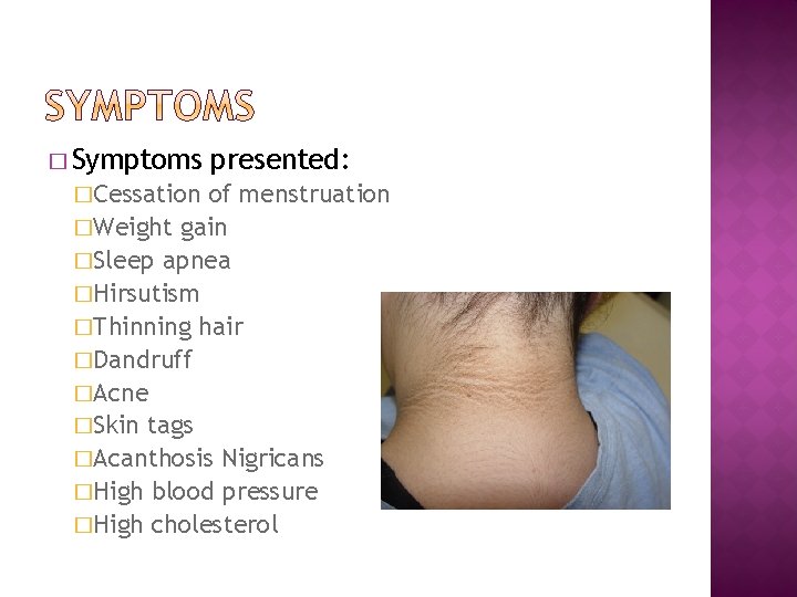 � Symptoms �Cessation presented: of menstruation �Weight gain �Sleep apnea �Hirsutism �Thinning hair �Dandruff