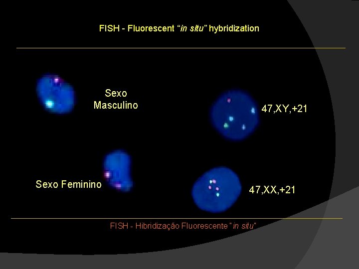FISH - Fluorescent “in situ” hybridization Sexo Masculino Sexo Feminino 47, XY, +21 47, FISH - Fluorescent “in situ” hybridization Sexo Masculino Sexo Feminino 47, XY, +21 47,