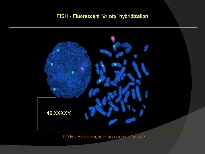 FISH - Fluorescent “in situ” hybridization 49, XXXXY FISH - Hibridização Fluorescente “in situ” FISH - Fluorescent “in situ” hybridization 49, XXXXY FISH - Hibridização Fluorescente “in situ”
