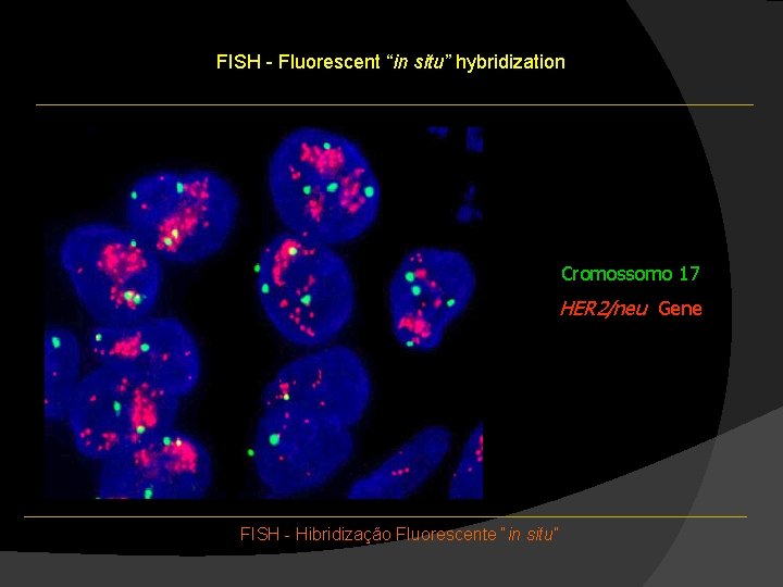 FISH - Fluorescent “in situ” hybridization Cromossomo 17 HER 2/neu Gene FISH - Hibridização FISH - Fluorescent “in situ” hybridization Cromossomo 17 HER 2/neu Gene FISH - Hibridização