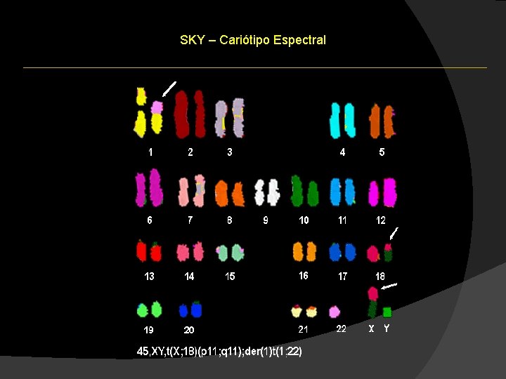 SKY – Cariótipo Espectral SKY – Cariótipo Espectral
