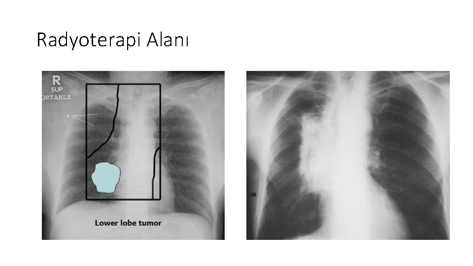 Radyoterapi Alanı 
