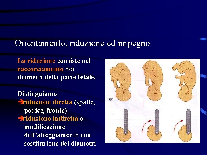 Orientamento, riduzione ed impegno La riduzione consiste nel raccorciamento dei diametri della parte fetale.