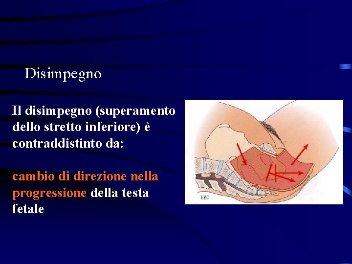 Disimpegno Il disimpegno (superamento dello stretto inferiore) è contraddistinto da: cambio di direzione nella