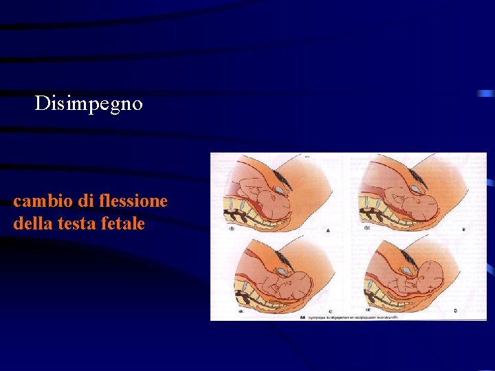 Disimpegno cambio di flessione della testa fetale Disimpegno cambio di flessione della testa fetale