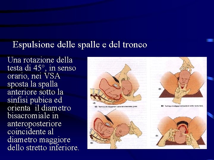 Espulsione delle spalle e del tronco Una rotazione della testa di 45°, in senso Espulsione delle spalle e del tronco Una rotazione della testa di 45°, in senso