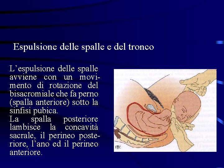 Espulsione delle spalle e del tronco L’espulsione delle spalle avviene con un movimento di