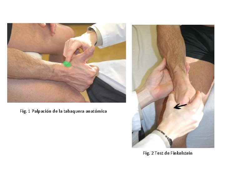 Fig. 1 Palpación de la tabaquera anatómica Fig. 2 Test de Finkelstein Fig. 1 Palpación de la tabaquera anatómica Fig. 2 Test de Finkelstein