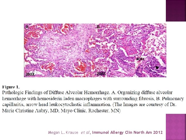 Megan L. Krause et al, Immunol Allergy Clin North Am 2012 