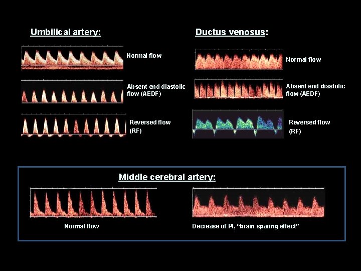 Ductus venosus: Umbilical artery: Normal flow Absent end diastolic flow (AEDF) Reversed flow (RF)