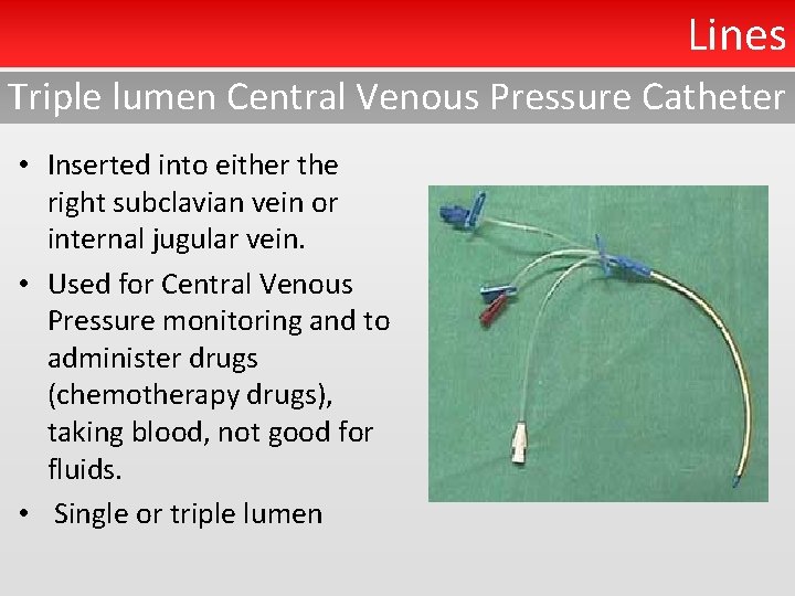 Lines Triple lumen Central Venous Pressure Catheter • Inserted into either the right subclavian