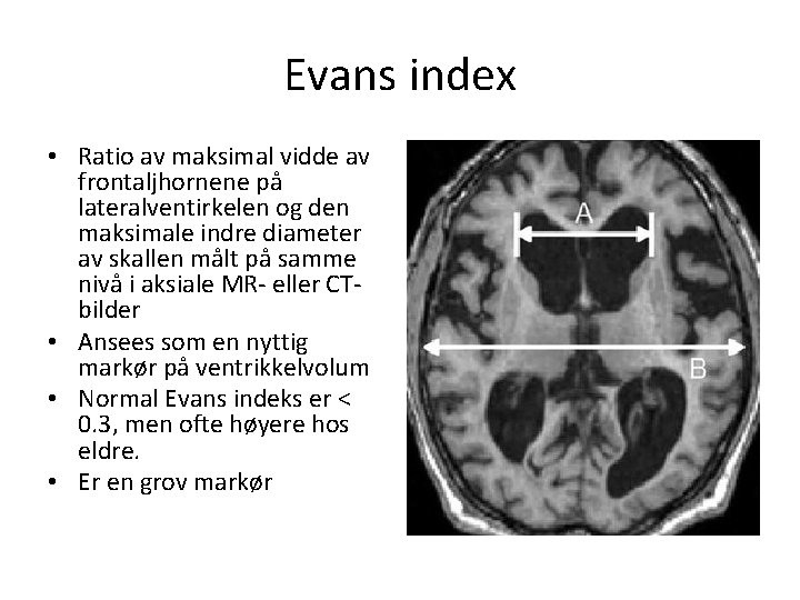 Evans index • Ratio av maksimal vidde av frontaljhornene på lateralventirkelen og den maksimale