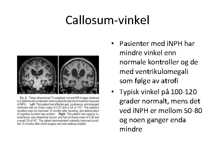 Callosum-vinkel • Pasienter med i. NPH har mindre vinkel enn normale kontroller og de