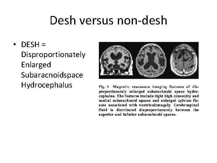 Desh versus non-desh • DESH = Disproportionately Enlarged Subaracnoidspace Hydrocephalus 
