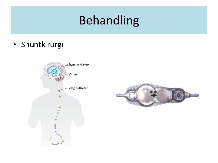 Behandling • Shuntkirurgi 