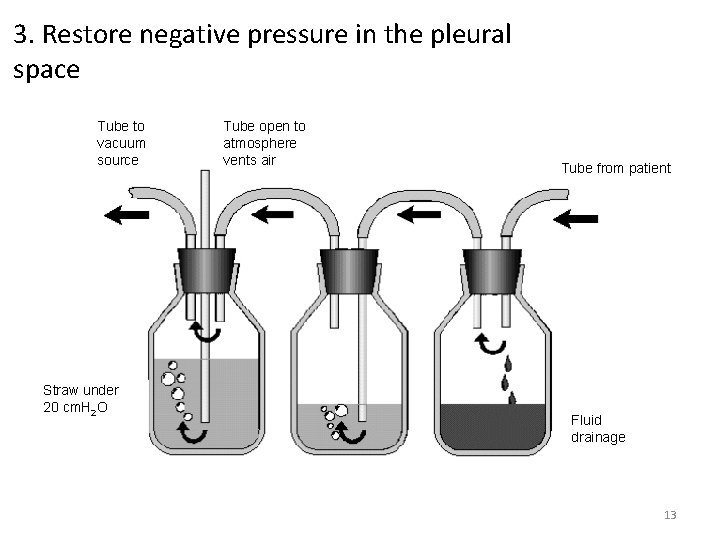 3. Restore negative pressure in the pleural space Tube to vacuum source Tube open