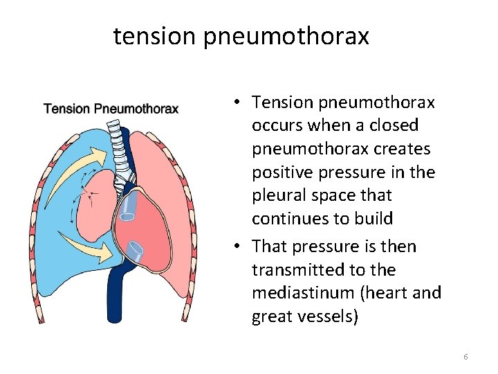 tension pneumothorax • Tension pneumothorax occurs when a closed pneumothorax creates positive pressure in