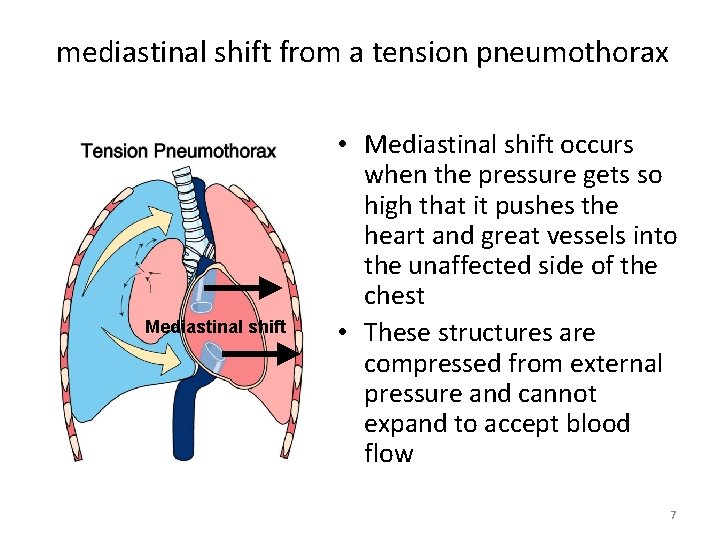 mediastinal shift from a tension pneumothorax Mediastinal shift • Mediastinal shift occurs when the