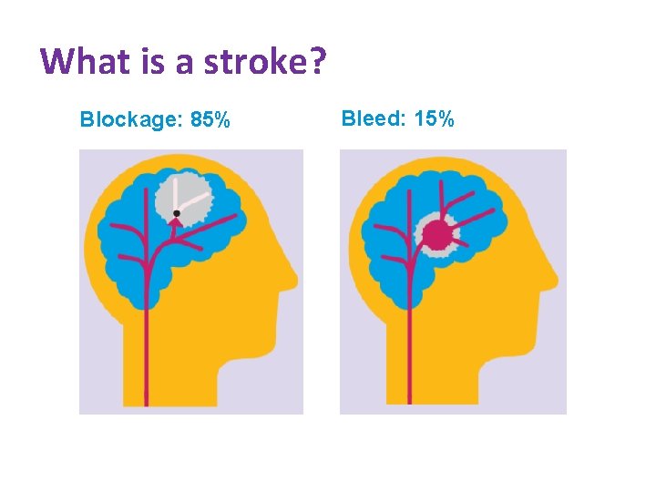 What is a stroke? Blockage: 85% Bleed: 15% 